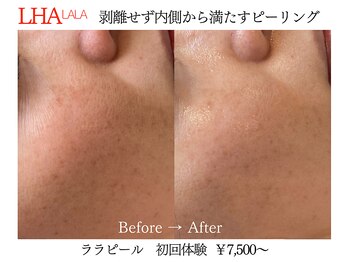 ビクトリー(VICTORY)/韓国肌管理ララピール