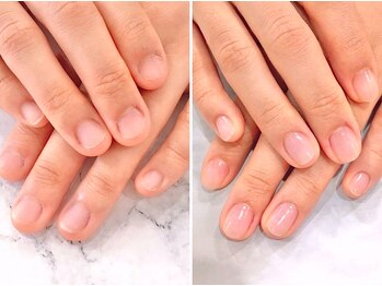 リファーレ(RIFARE)/【深爪矯正】丸いお爪からの変化