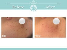 ゼロ美人 那覇店(ZERO美人)/【シミケア★シミケアZERO美人】