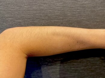 オアシスラグーン(OASIS LAGOON)/腕脱毛(症例1:before)