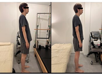 銀座鍼処 カナウ(KANAU)/猫背姿勢改善例