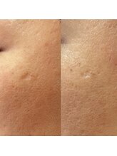 マヤヒメ(mayahime)&nbsp;お肌 お悩み