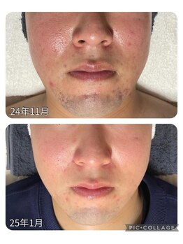 コンフィデンスサロン(Confidence Salon)/赤みとニキビケア