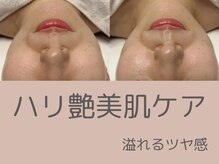 ベアール(beal)/艶美肌ハーブピーリング2回