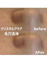 ブルームーン(BLUE MOON)/毛穴洗浄