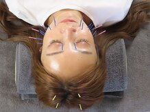 ビーネ 札幌琴似/ハリスリム 札幌琴似(Beene/Hari-Slim)/多すぎない適切な本数の美容鍼