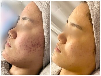 フルール(FLEUR)/肌荒れケア6ヶ月の結果☆