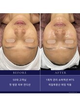 トータルクリア(TOTAL CLEAR)/韓国高級エステ「SUPERJECTION」