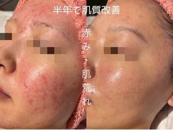 ビューティーサロンリア 栄 伏見店(LI'A)/肌質改善(半年の経過症例)