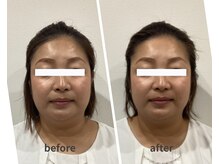 スリー治療院 伏見桃山(THREE治療院)/【むくみ改善】小顔矯正