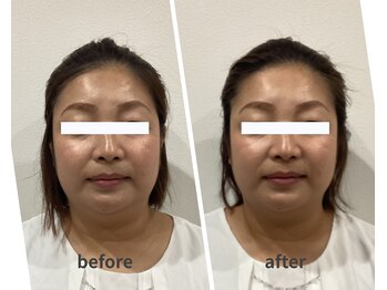 スリー治療院 伏見桃山(THREE治療院)/【むくみ改善】小顔矯正