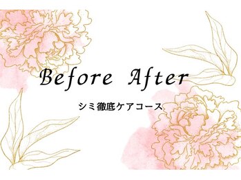 キレイ(KIREI)/シミ徹底ケアコース