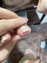ホナ(HONA)/巻き爪や陥入爪でお悩みの方