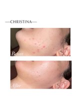 ビューティースタイリング 自由が丘店(beauty styling)/【乳酸ピーリング】