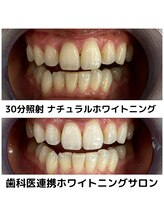 プラチナムビューティ 四条烏丸店(PLATINUM Beauty)/ホワイトニングビフォーアフター