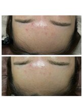 プレジール(PLAISIR)/ハーブピーリングBefore・After