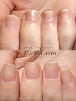 マリーロール 梅田店(Marie Laure)/自爪育成/深爪矯正/ネイルケア