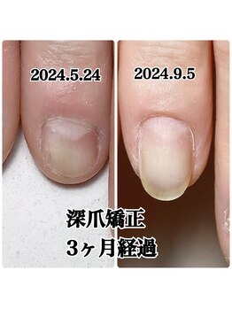 深爪矯正で爪を伸ばす