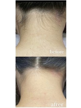 メルシー13/うなじ脱毛