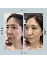 ラプティット(La petite)/50代女性/1回の変化