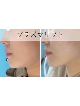 ナーズ(NAZ)/プラズマリフト