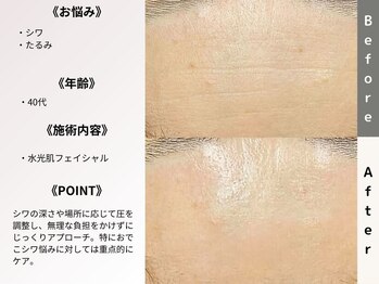 ルディラ 銀座店/水光肌フェイシャル