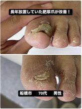 巻き爪じゅん 千葉駅前店/長年放置された肥厚爪が改善！