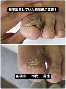 長年放置された肥厚爪が改善！
