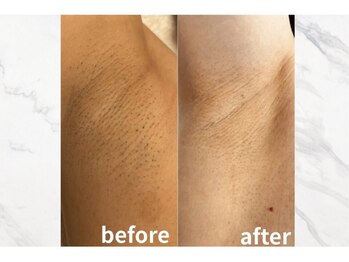 ボゴス 天白店(BOGOSS)/【脇脱毛】施術写真