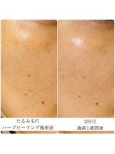 ラ セルフィー(Ra Selfee)/ハーブピーリング症例