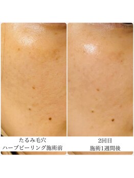 ラ セルフィー(Ra Selfee)/ハーブピーリング症例