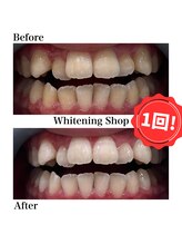 ホワイトニングショップ 新宿店/【ホワイトニング】BeforeAfter