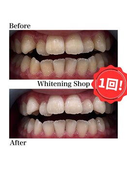 ホワイトニングショップ 新宿店/【ホワイトニング】BeforeAfter