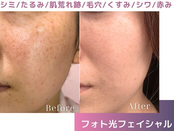 エープラス(A+)/フォト光フェイシャル