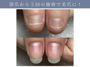 イデアル(ide’al)/深爪でお悩みの学生のお客様