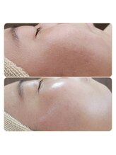 アンティクイーン(Antiqueen)/最新の天然針エステ