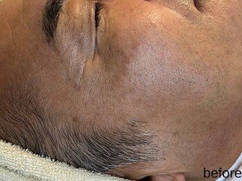 サロン ド エメ(salon de aimer)/【Before】最高峰エイジングケア