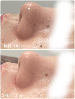 ミレーヴ(MiReve)/ハーブピーリング