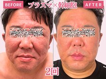 べモーレ 上本町 谷町九丁目(Bemolle)/50代プラズマ×幹細胞2回☆