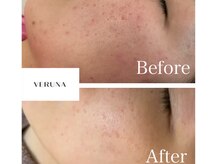 アトワ(A toi)/ハーブピーリング(ハード)