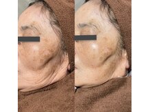 リラチル(relachill)/光フェイシャル