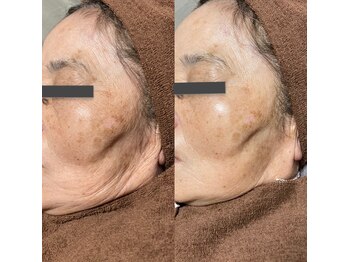 リラチル(relachill)/光フェイシャル