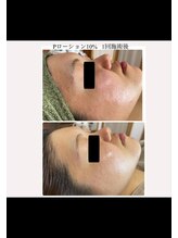 サロン キママ(Salon Kimama)/ハーブピーリング・BeforeAfter