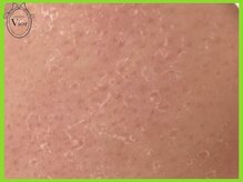 ハーブピーリング 名古屋/ハーブピーリング