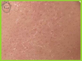 ハーブピーリング 名古屋/ハーブピーリング