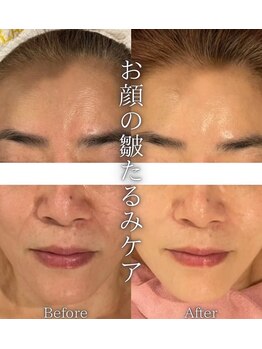 ビュウナ 銀座(BEAUNA)/マルチウェーブリフト