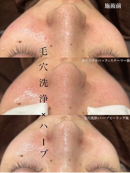 レア 姫路店(le'a)/毛穴洗浄×ハーブピーリング