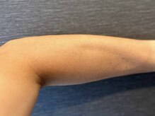 オアシスラグーン(OASIS LAGOON)/腕脱毛（症例２：after）