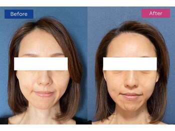 ミューズ よもぎ蒸し(MUSE)/◆サーマクール◆