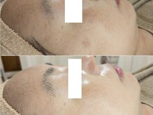 アン(anne)/ハーバルピール☆ レベル4×4回